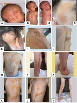 Case Report: Sequential postzygotic HRAS mutation and gains of the paternal chromosome 11 carrying the mutated allele in a patient with epidermal nevus and rhabdomyosarcoma: evidence of a multiple-hit mechanism involving HRAS in oncogenic transformation